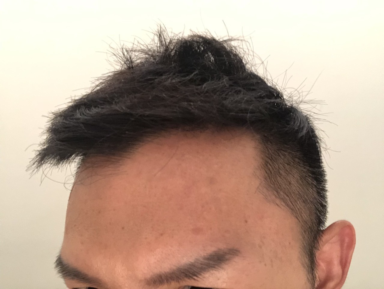 痘痘一直没好？因为你踩到4种地雷　难怪痘痘长不停